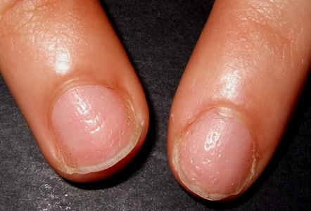 On fingernails indents small Why Does